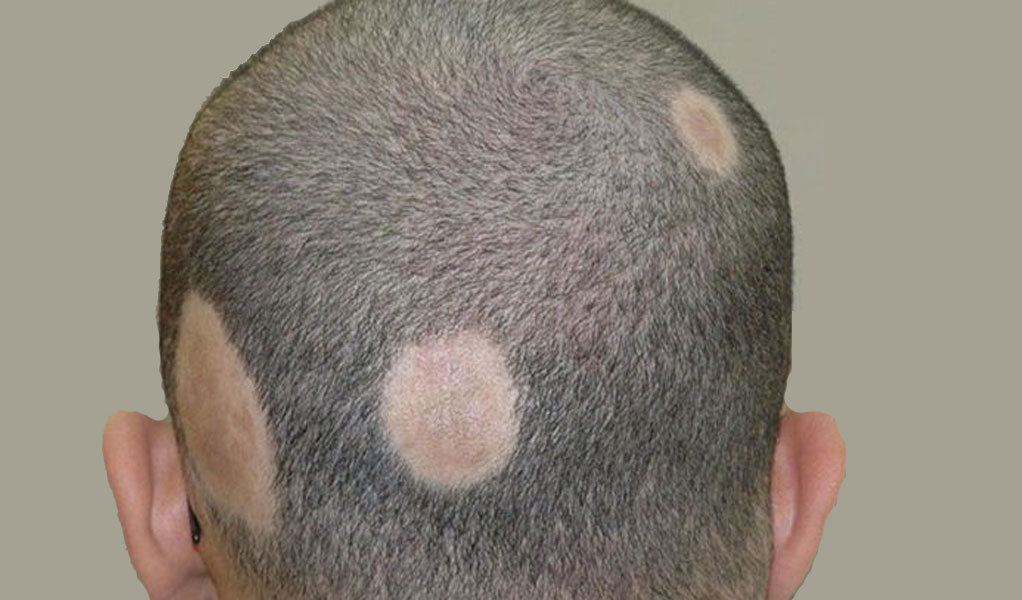 Advanced Hair Design: Best Hair Patch For Alopecia - Charming Look Hair Studio Advanced Hair Design: Best Hair Patch For Alopecia - Charming Look Hair Studio